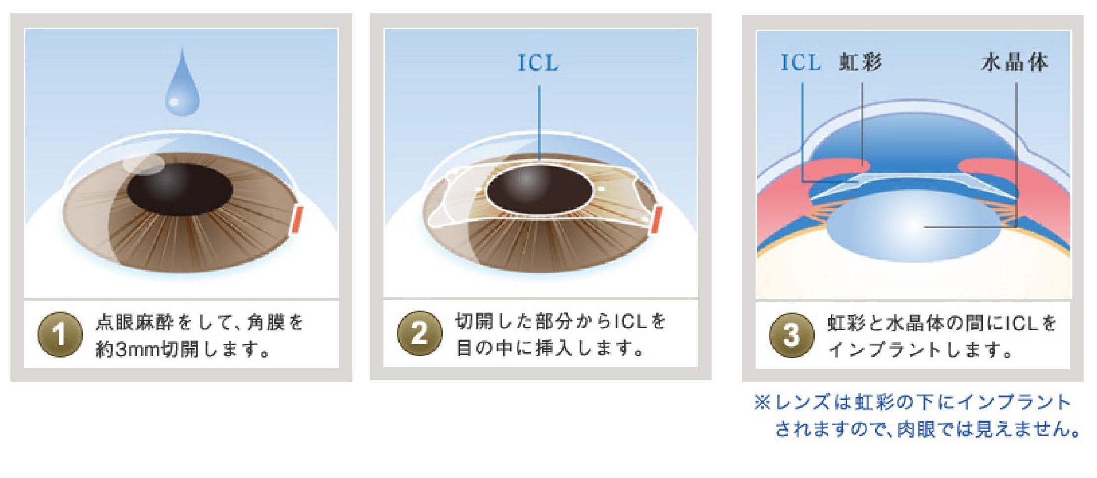 視力回復手術を語る 第5回 眼内レンズで視力回復 フェイキックiol概論 表参道眼科マニア