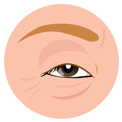 眼瞼下垂とは 眼科ドック アイドックを受けてみよう 表参道眼科マニア